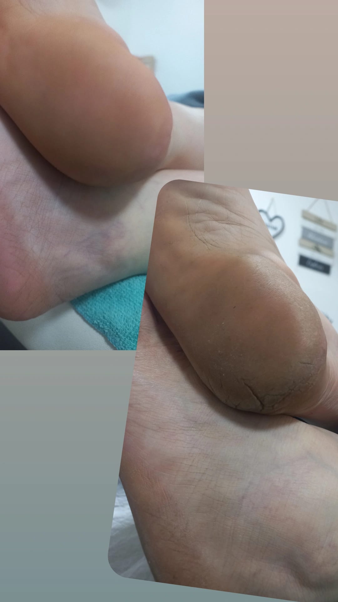 قبل وبعد — علاج تشققات الكعب